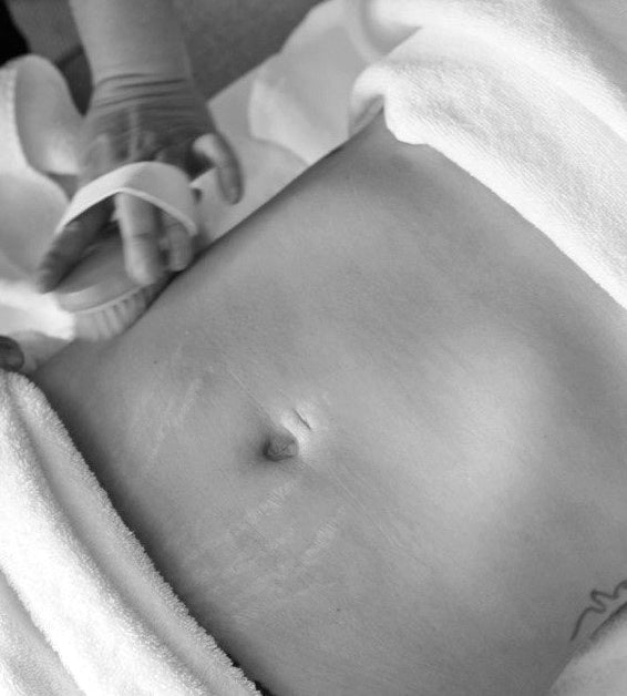 True Lymphatic Drainage (TLD)